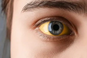 برای زردی چشم چه بخوریم