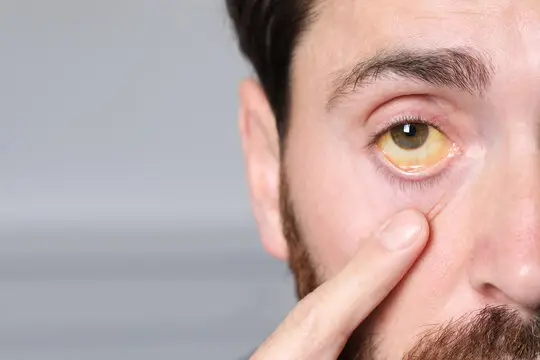 برای زردی چشم چه بخوریم