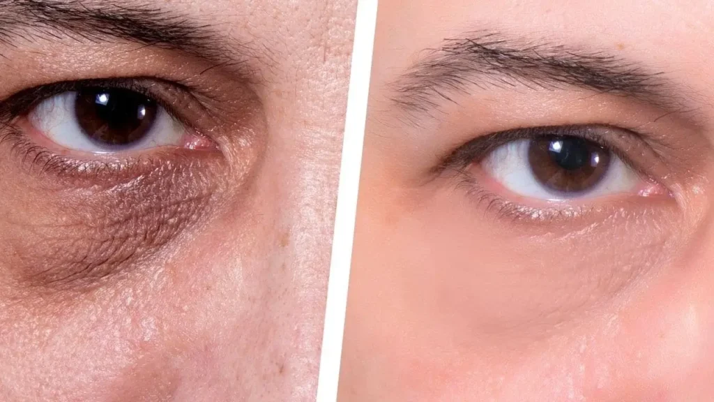 رفع دائمی چروک زیر چشم